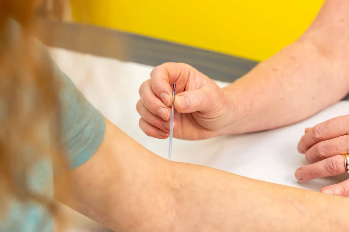Acupuncture 1